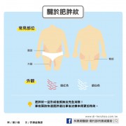 快速肥胖，小心肥胖紋糾纏／文：許錦銓醫師