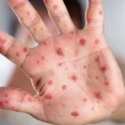 麻疹爆發！怎麼預防、什麼人該打疫苗？快速搞懂防疫心法！／文：洪啟偉醫師